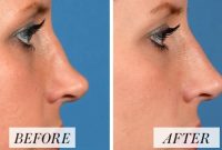 Non-Surgical Nose Job, Charleston - Nose Reshaping Without Surgery | Dr ... Non-Surgical Nose Job, Charleston - Nose Reshaping Without Surgery | Dr ...