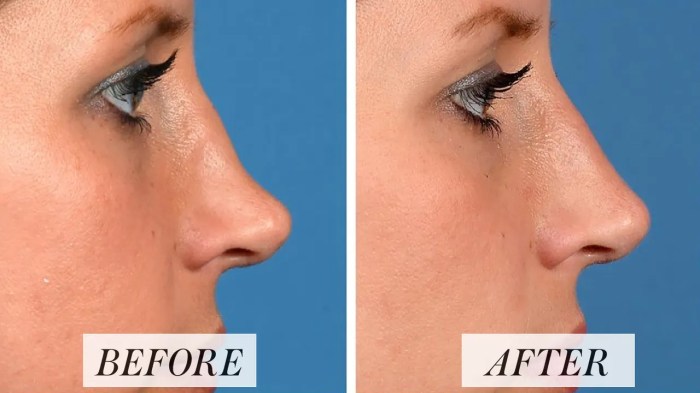 Non-Surgical Nose Job, Charleston - Nose Reshaping Without Surgery | Dr ... Non-Surgical Nose Job, Charleston - Nose Reshaping Without Surgery | Dr ...